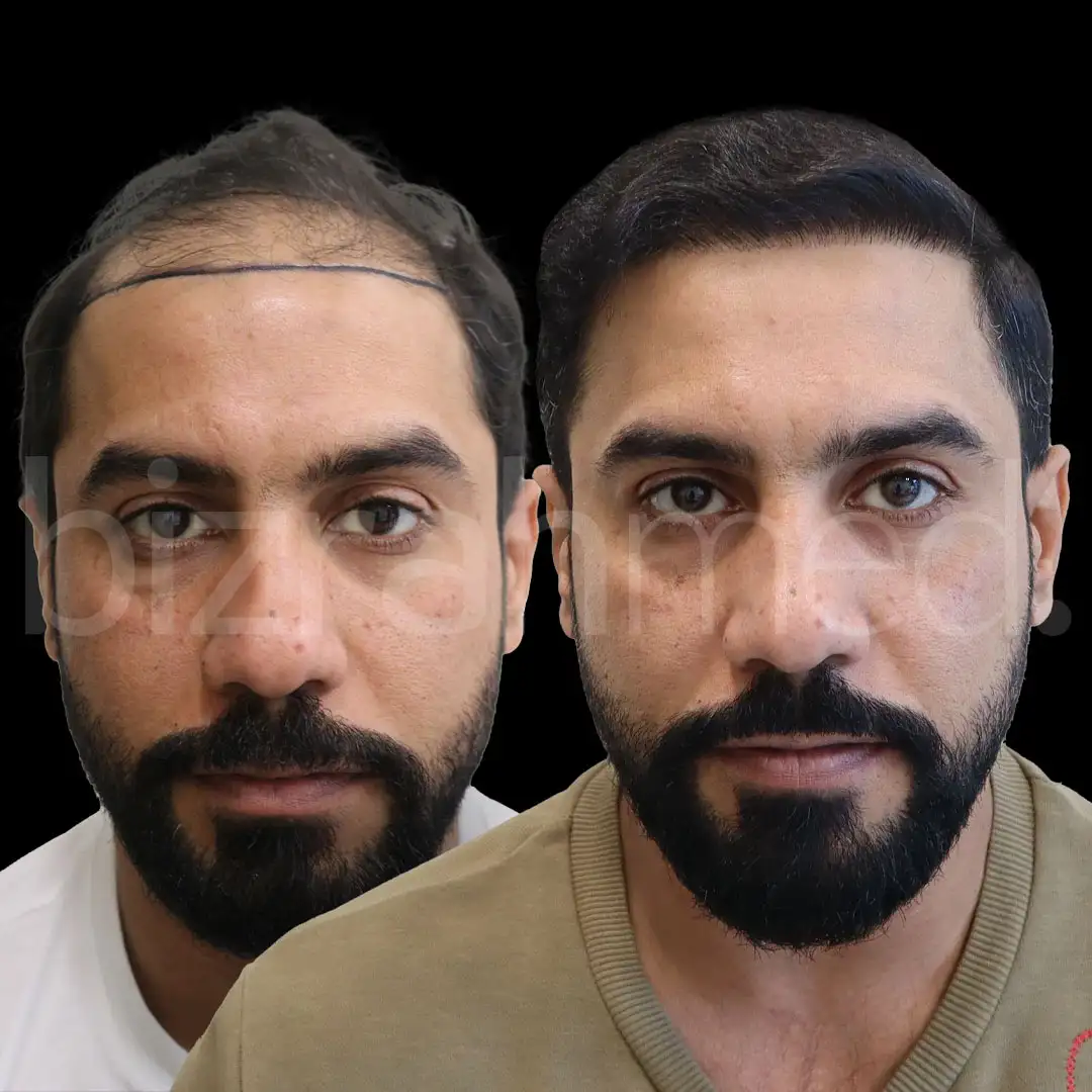 Scalp Micropigmentation in Dubai